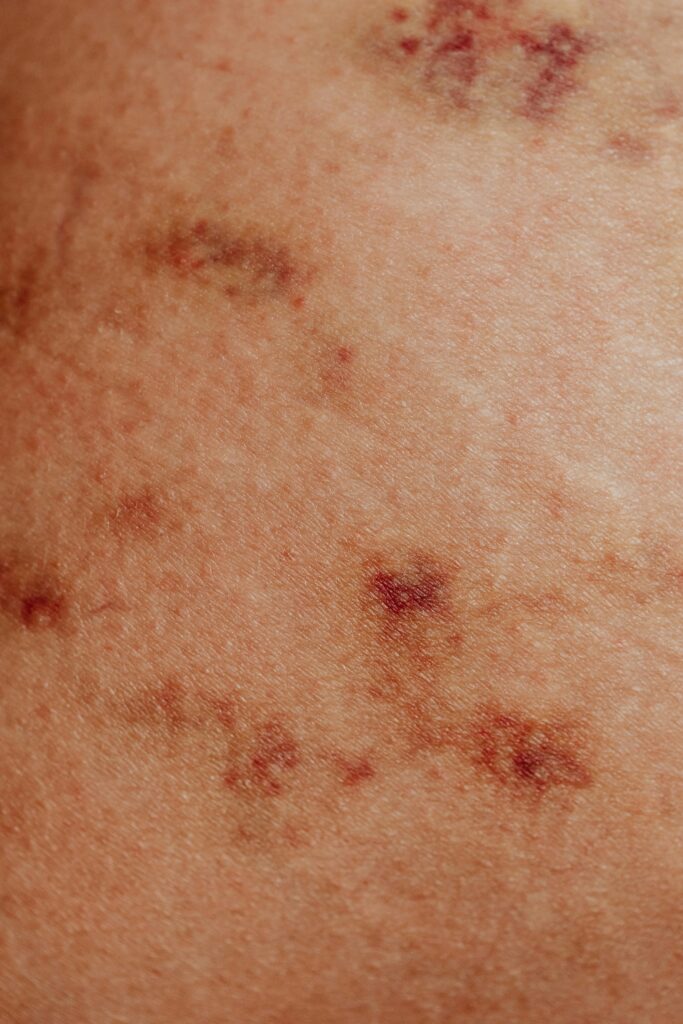 Detailed view of skin with red spots and discoloration, common in dermatology studies.